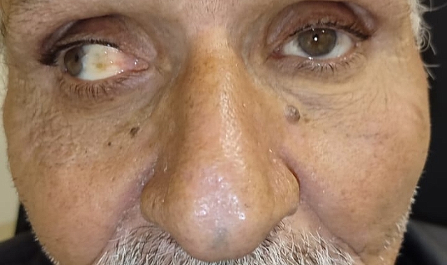 Harran Üniversitesi Hastanesi'nden Başarılı Operasyon