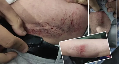 Harran Üniversitesi’nde korkuyu yaşadı! Yaralı öğrenci: Maalesef ki köpekten değersiziz!