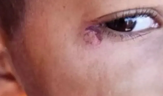 Urfa’da korkunç iddia! Temizlik görevlisi, öğrencinin yüzünde sigara söndürdü!