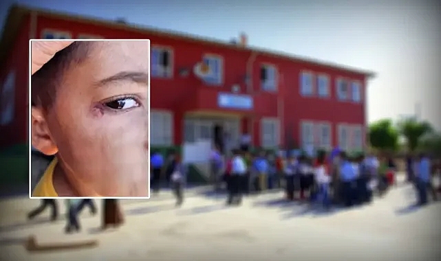Urfa’da öğrencinin yüzünde sigara söndürülme olayında yeni gelişme!