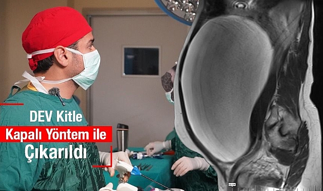 Dev Kitle Başarıyla Alındı: 47 Yaşındaki Kadın Sağlığına Kavuştu